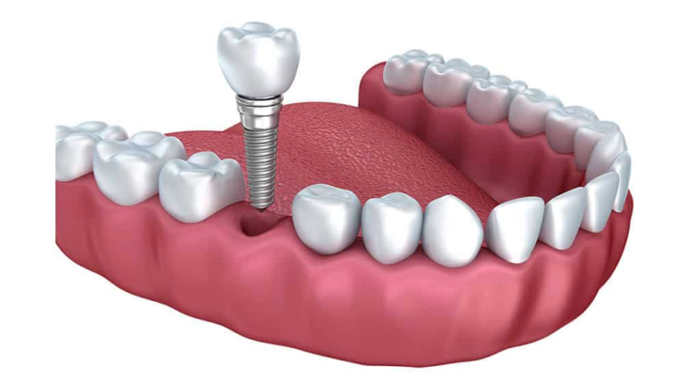 Questions to Ask Before Choosing an Implant Dentist in Palmdale