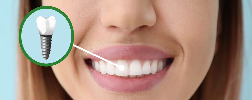 Dental Implants Near Me