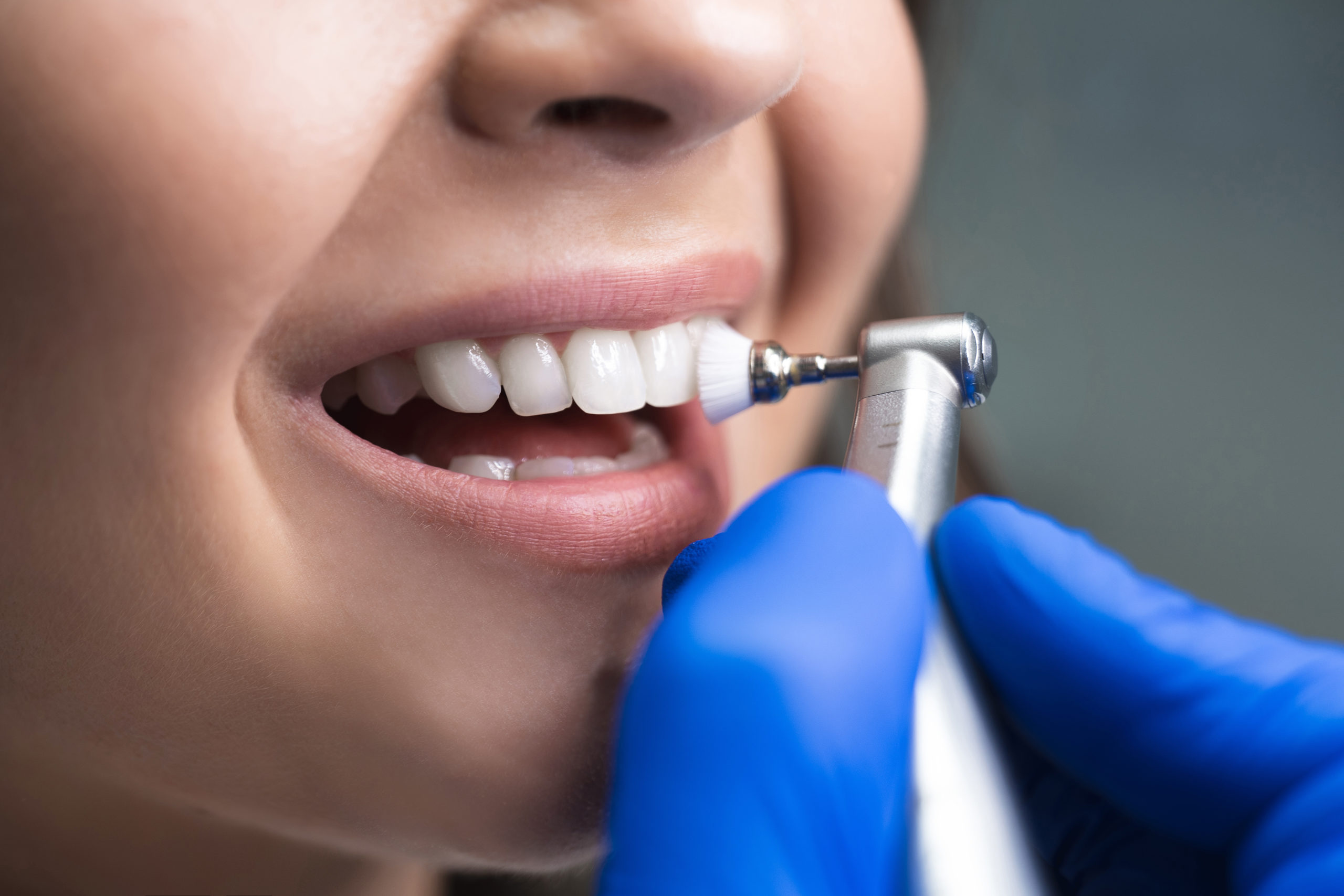 dental cleaning in Los Angeles