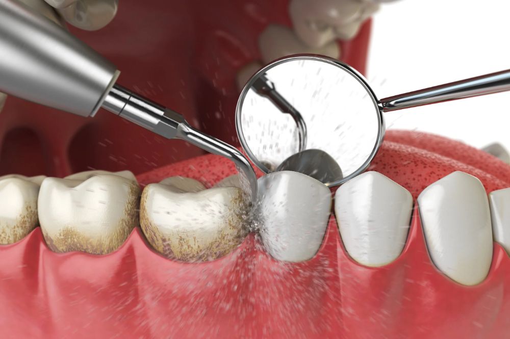 dental cleaning near me